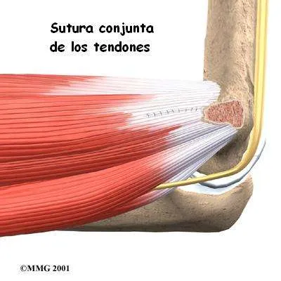 Cirugía de epitrocleitis 4