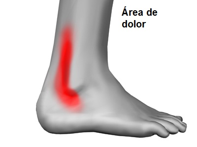 Síntomas tendinitis peronea