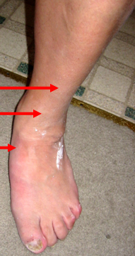 Tendinitis tibial anterior