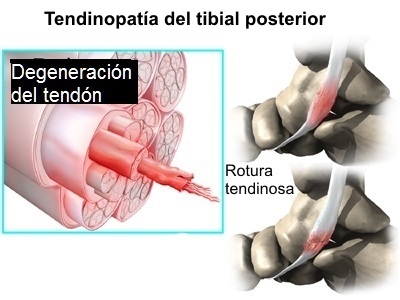 Estadios de la disfunción del tibial posterior
