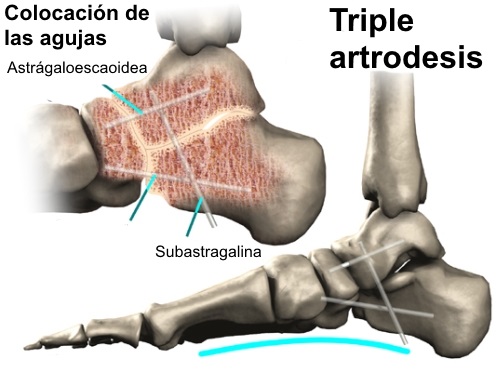 Artrodesis del retropié