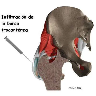 Infiltración en la bursitis trocantérea