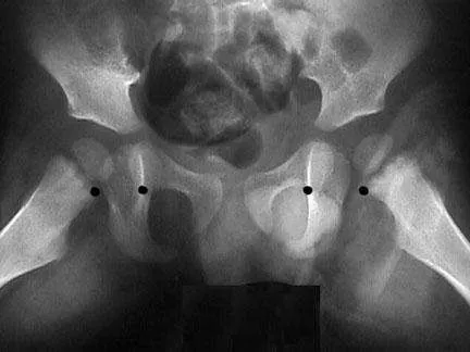 Radiografía con aumento del espacio articular en la cadera afectada