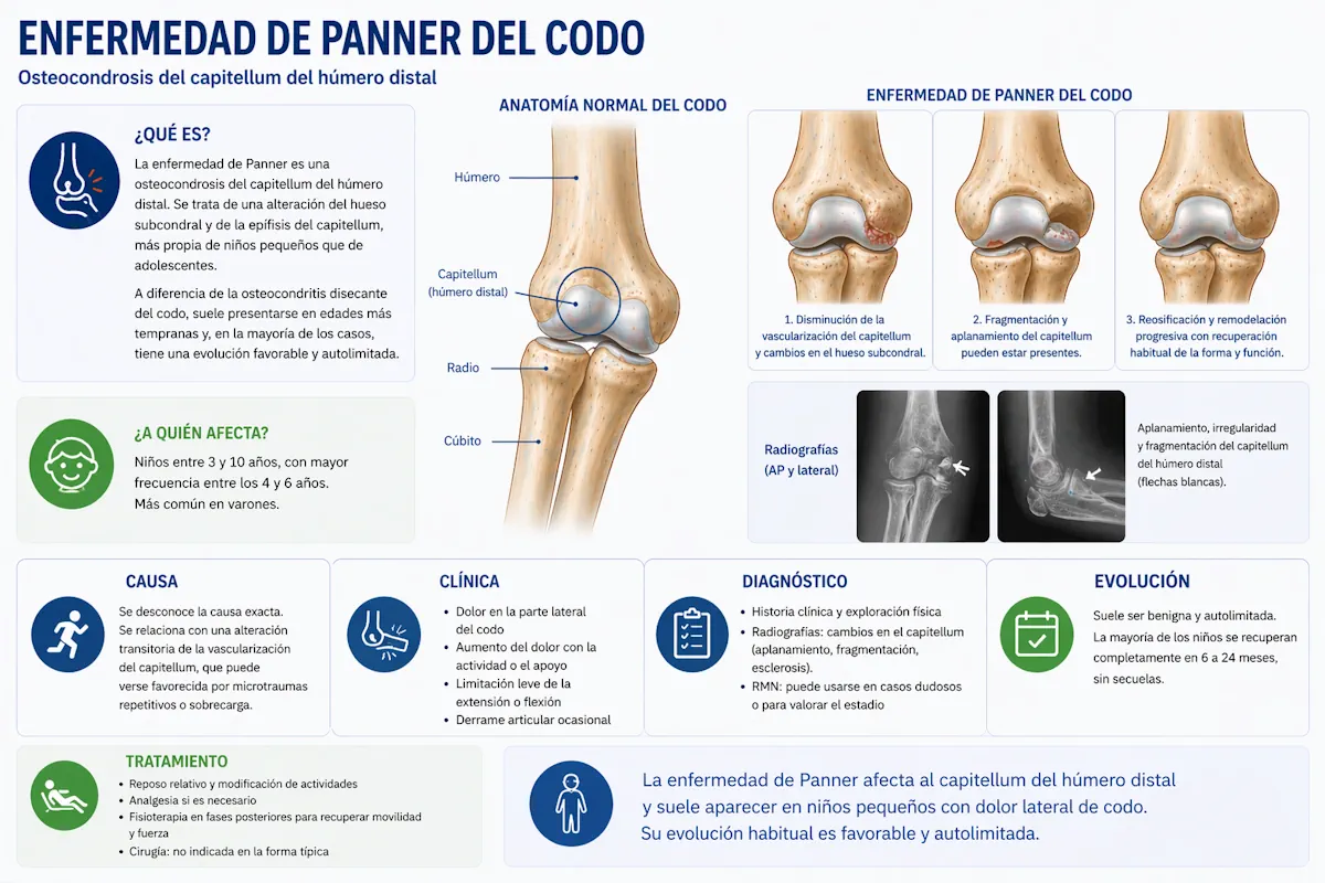 Enfermedad de Panner del codo