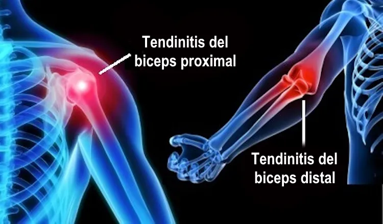 Tendinitis distal del bíceps en el codo