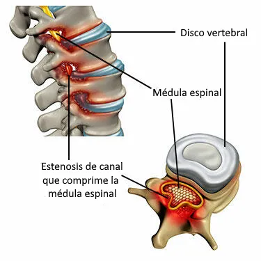 Ejemplo anatómico de estenosis en la columna lumbar
