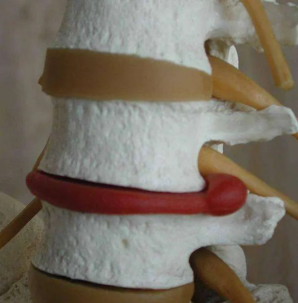 Visión lateral de hernia discal lumbar
