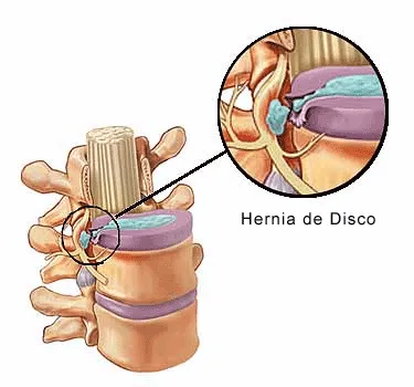 Hernia discal lumbar completa