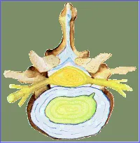 Fisura discal lumbar