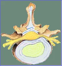 Protrusión discal lumbar