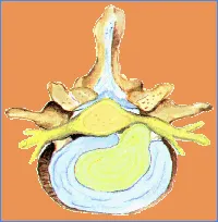 Hernia discal lumbar