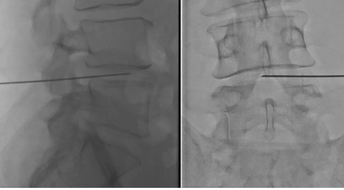 Acceso percutáneo intradiscal para ozonoterapia en hernia lumbar