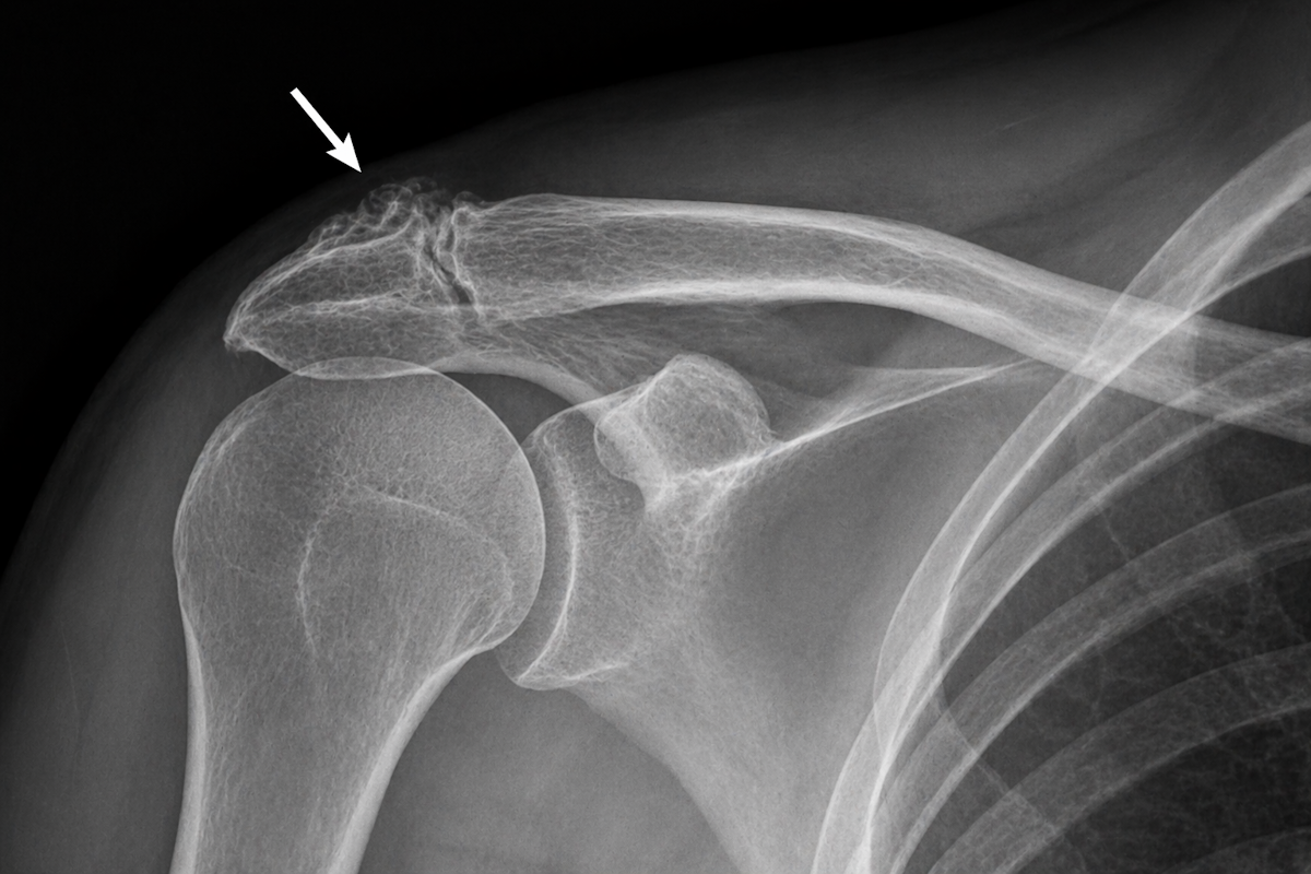Radiografía con signos de artrosis acromioclavicular