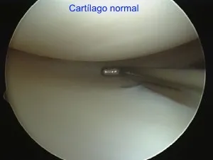 Cartílago articular normal