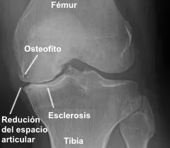 Osteofitos y signos radiológicos de artrosis