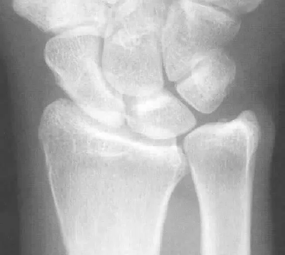 Varianza cubital positiva en radiografía de muñeca