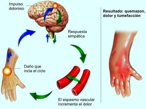 Síndrome de dolor regional complejo