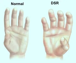 Edema en SDRC