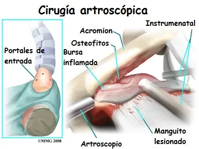 Artroscopia de hombro