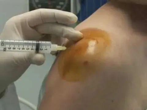 Infiltración subacromial del hombro