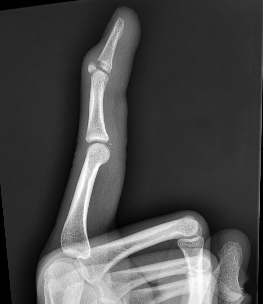 Radiografía lateral de dedo en martillo óseo con arrancamiento de la falange distal