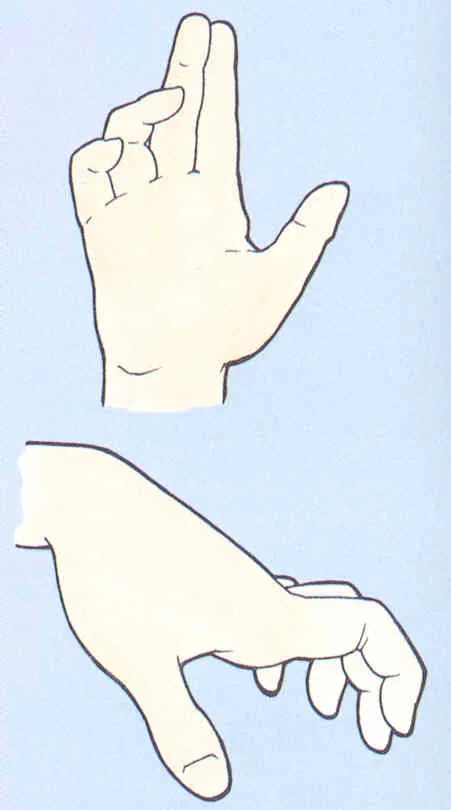 Mano en garra por afectación del nervio cubital