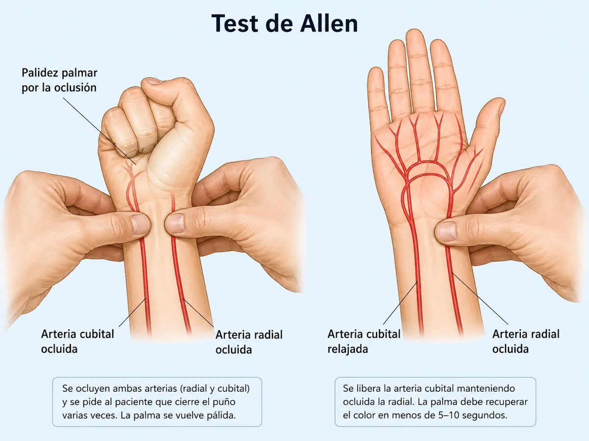 Test de Allen para valorar circulación de la mano