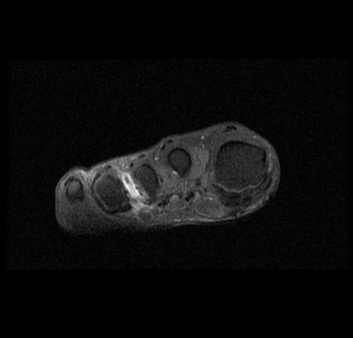 Resonancia magnética axial de bursitis intermetatarsiana