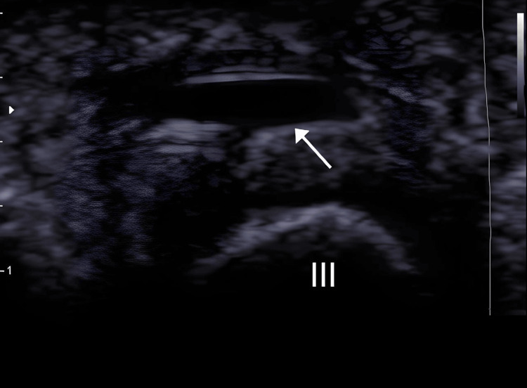 Ecografía de bursitis intermetatarsiana