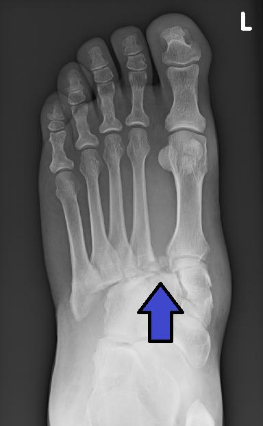Radiografía en carga de lesión de Lisfranc del mediopié
