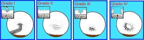 Ejemplo de lesión condral de rodilla