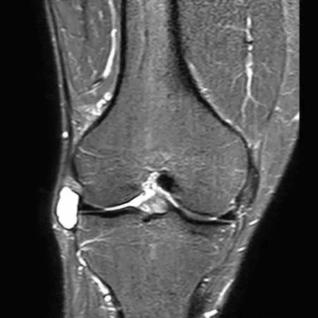 Resonancia magnética de quiste meniscal