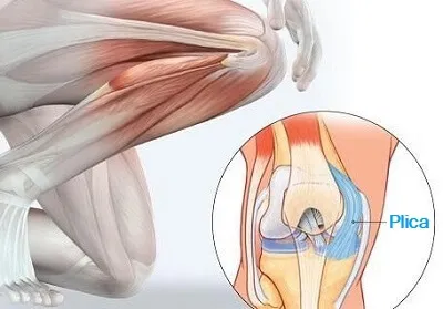 Imagen de resonancia magnética de la plica sinovial de la rodilla