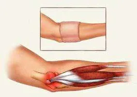 Brazalete para epicondilitis