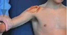 Exploración del subescapular 1