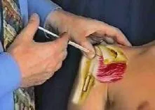 Infiltración del subescapular 3