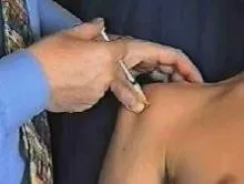 Infiltración del subescapular 4