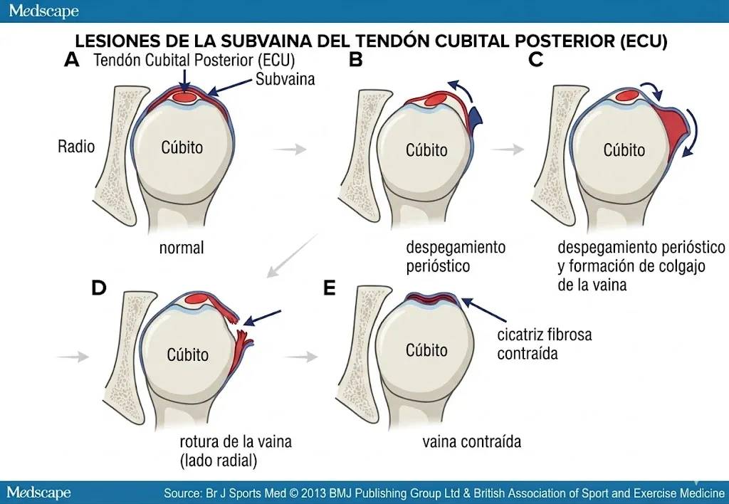 Tipos de rotura de la subenvoltura del ECU