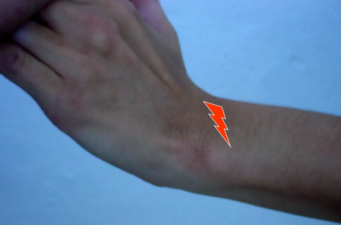 Tendinitis del extensor cubital del carpo