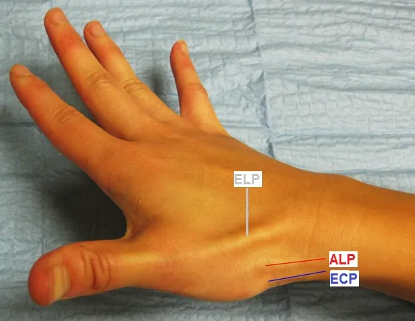 Dolor en el extensor largo del pulgar