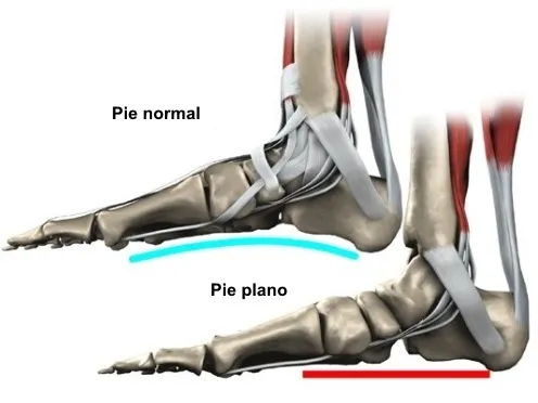 Resonancia magnética del tibial posterior